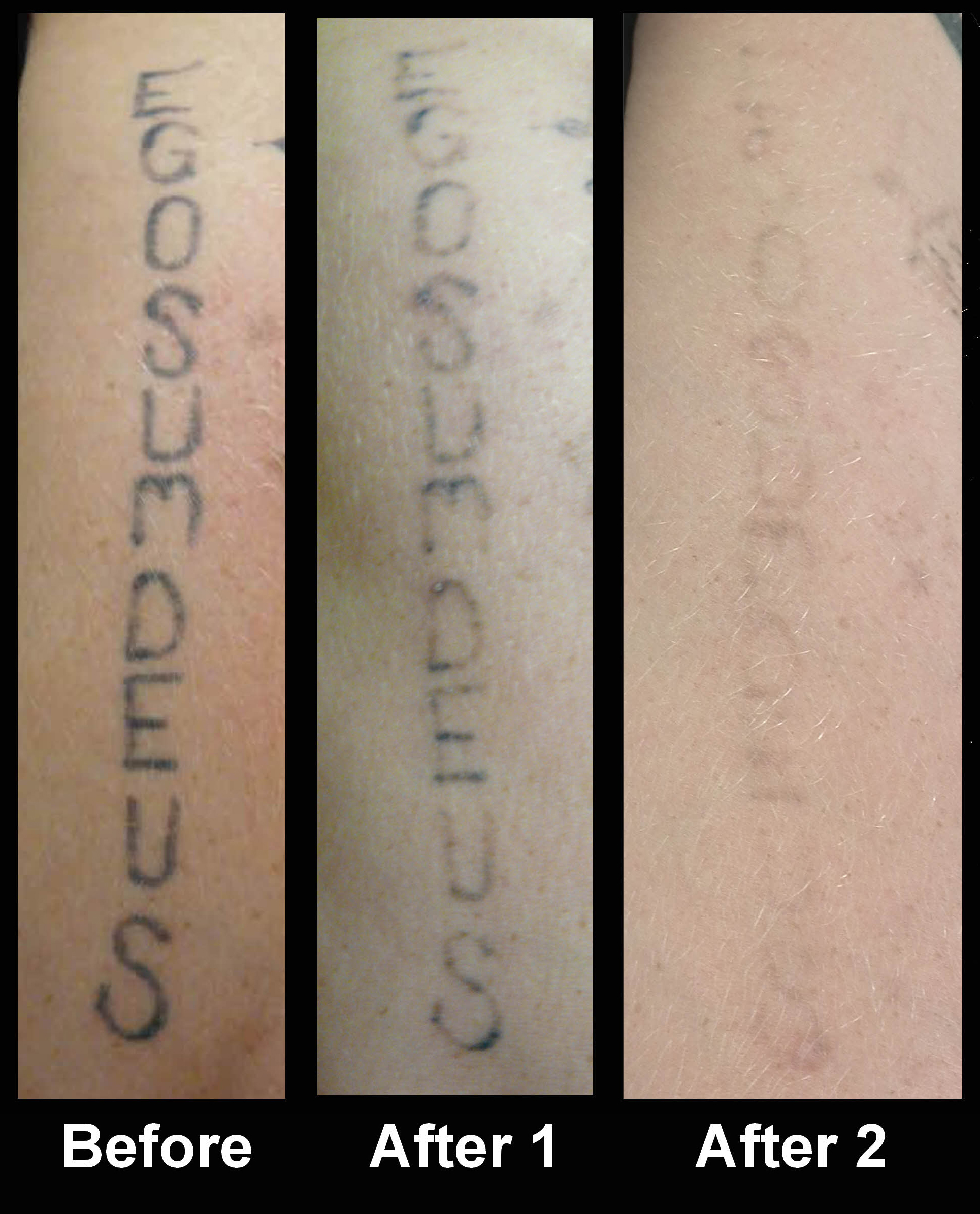 Laser tattoo removal, 2 sessions - BeauLine Aesthetics Laser tattoo removal, 2 sessions - BeauLine Aesthetics